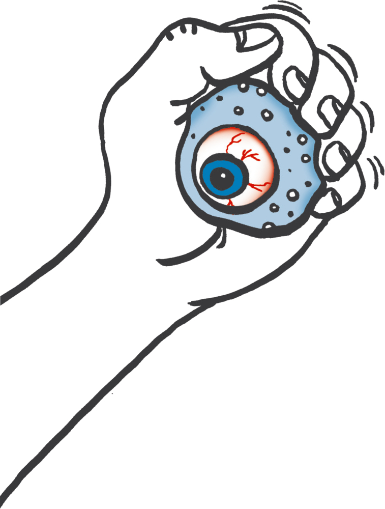Gezeichnete Hand quetscht einen druckempfindlichen Ball in Form eines Augapfels mit blauer Iris.